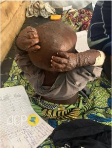 RD Congo: Impuruza ku bana bato bibasiwe cyane n'ikiza cy'ubushita bw'inkende 