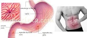Sobanukirwa indwara ya cancer y'igifu, ibimenyetso byayo n'uko wayirinda