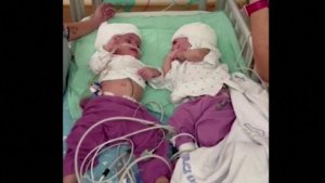 Israel: Impanga zavutse zifatanye zatandukanyijwe 