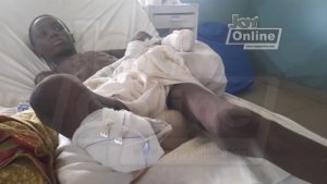 Umwana w'imyaka 14 yaciye ukuguru n'ukuboko nyuma yo kumenwaho Aside n'umwarimu wamushinjaga kumwiba igare