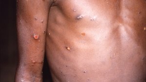  Cyiganje cyane mubaryamana bahuje ibitsina! Icyorezo cya monkeypox gikomeje kuyogoza Isi