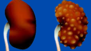 Dore ibintu 5 byangiza impyiko cyane abantu benshi batazi