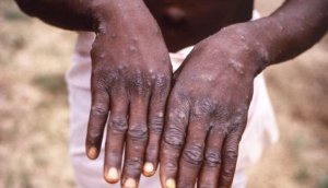 Indwara y'ubushita bw'inkende igihe gutangazwa nk'ikibazo gikomeye 