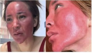 Umugore yahiye uruhu rwo mu maso nyuma yo kumara imyaka 22 atihanagura make-up