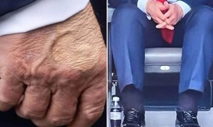 Perezida Trump yasanganywe indwara y'imitsi