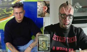 Umugabo akomeje guca ibintu hose nyuma yo gutakaza akayabo k'amafaranga bakamukuraho ibice by'umubiri we birimo n'amatwi