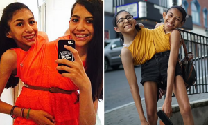 Umwe mu bakobwa babiri bavutse bafatanye yavuze ko yabonye umukunzi [AMAFOTO]