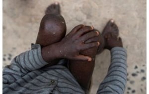 FDA yemeje urukingo rukwiriye gukoreshwa mu gukingira 'Monkeypox'