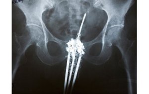 U Rwanda rugiye gutangiza ubundi buryo bwo kuvura kanseri bwitwa ‘Brachythérapie'