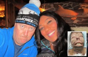 Yababariye umugabo we wamutwitse umubiri wose akamara amezi 6 mu bitaro