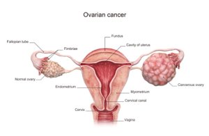 Abagore: Dore ibimenyetso byakugaragariza ko urwaye Kanseri y'udusabo tw'intanga(Ovarian Cancer)