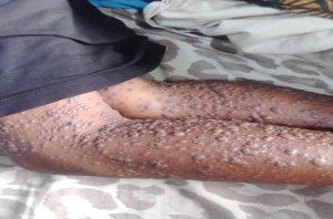 Burundi: Barembejwe n'icyorezo kibasira uruhu kikanafata imyanya y'ubuhumekero