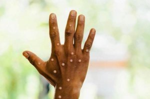 MINISANTE yatanze impuruza ku cyorezo cya Mpox(Ubushita bw'inkende)