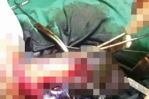 Umugabo yavunitse igitsina ari gutera akabariro bitera ubwoba umuganga we