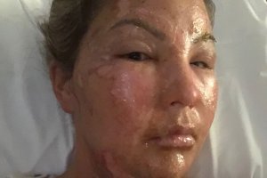 Umugore yatwitswe isura na hand sanitiser yafashwe n'umuriro ubwo yari ari gucana Buji