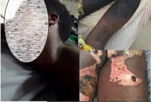 Rwamagana: Umukozi wo mu rugo ararembye nyuma yo gutwikwa na nyirabuja bapfa gukingura