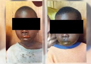 Burundi: Umugore yatwitse iminwa y'abana yareraga akoresheje ikiyiko gishyushye abaziza kurya indagara