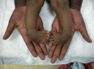 Uburwayi bw'ingingo buzwi nka ‘Clubfoot' buravurwa bugakira