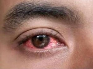 Kenya: Ibivugwa ku ndwara y'amaso atukura yibasiye Umujyi wa Mombasa