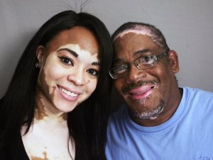 Sobanukirwa indwara ya Vitiligo yibasira uruhu. Ese iravurwa igakira? Ese irandura? Ntucikwe
