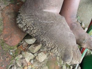 Imyumvire nkene ikomeje kuba intambamyi mu kurwanya indwara zititaweho mu Rwanda