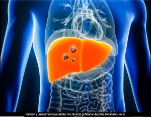 Kanseri y'umwijima ishobora kwikuba kabiri bitarenze mu 2050 - Ubushakashatsi