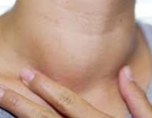 Ibyo benshi batazi ku ndwara y'umwingo, ukiyetera, ibimenyetso byayo n'uko yirindwa