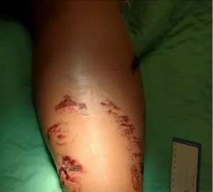 Umukobwa yigaranzuye ingona yamufashe ukuguru ari koga mu nyanja