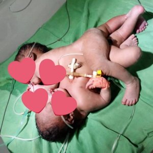 Kigali: Abana babiri bavutse bafatanye bapfuye abaganga bari kugerageza kubatandukanya